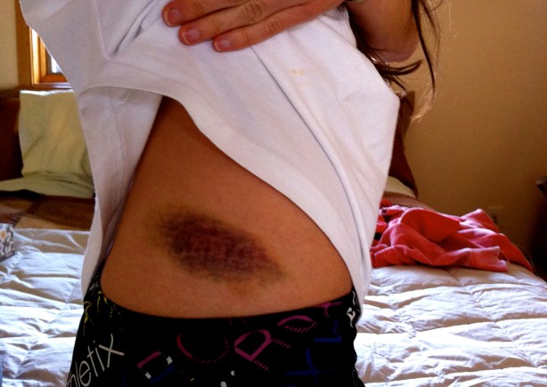 bruise